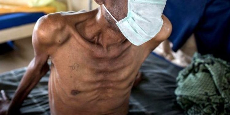 Plateau: Tuberculosis, TB cases on the rise — over 10,000 recorded in 2022